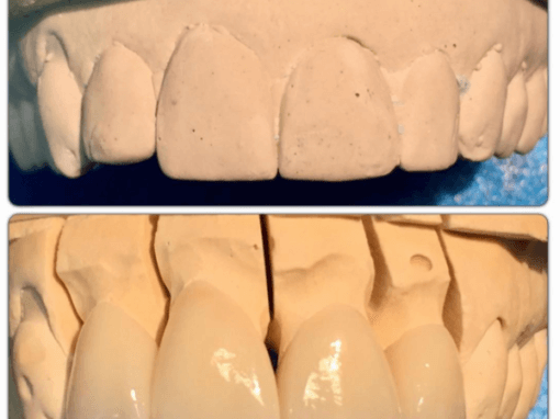 Zirconia crowns