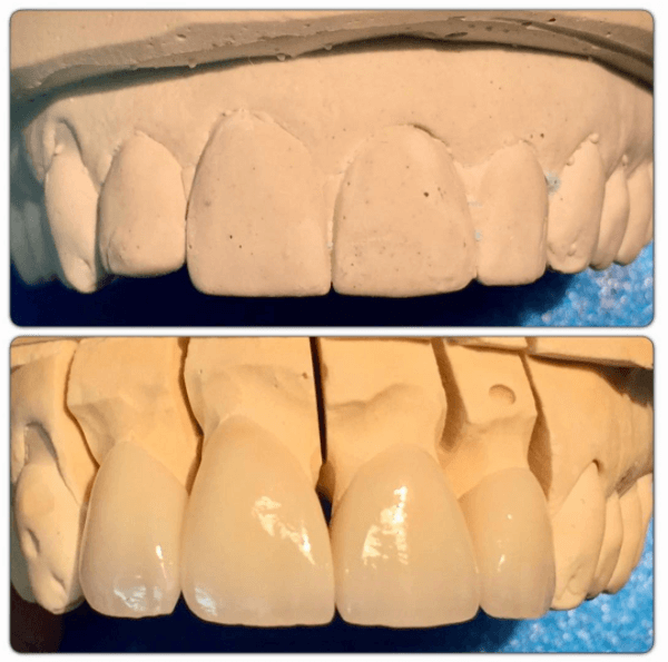 2-2 Zirconia crowns