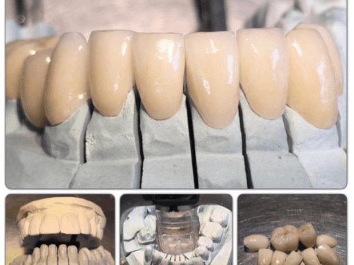 Pressed and Layered emax Veneers