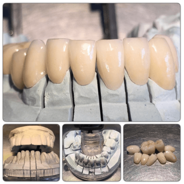 3-|-4 Pressed and Layered emax Veneers