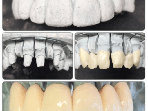 Zirconia Bridges