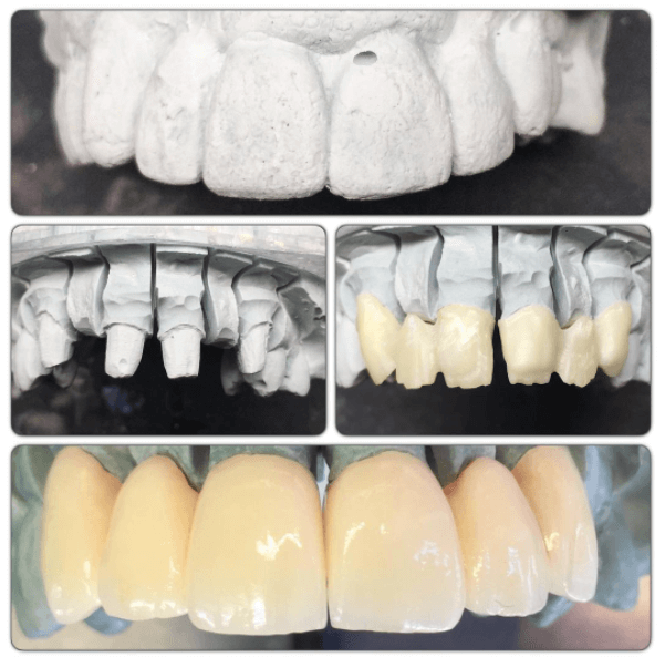 Zirconia Bridges