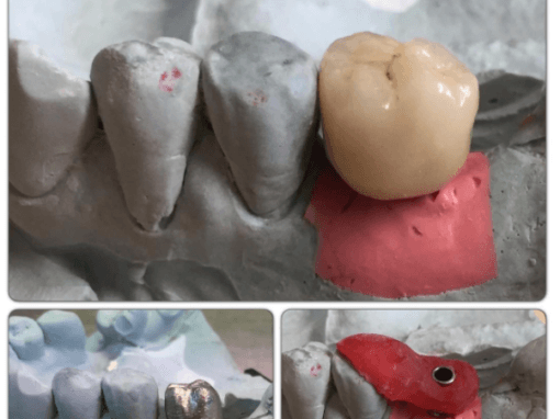 Mis-implant cement retained restoration