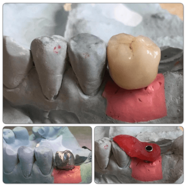 mis-implant cement retained restoration