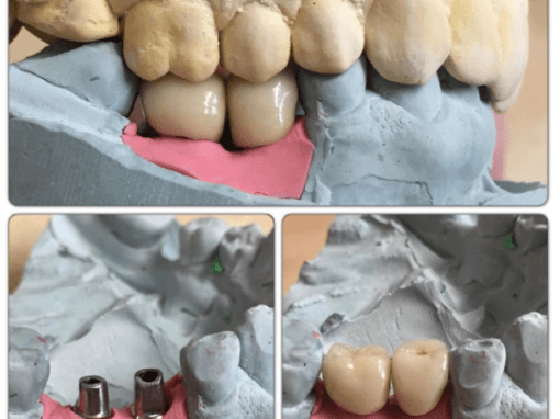 Two completed mis-implant restorations on Transgingival cement retained abutments