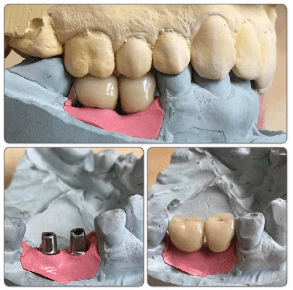 Two completed #misimplant restorations on Transgingival cement retained abutments